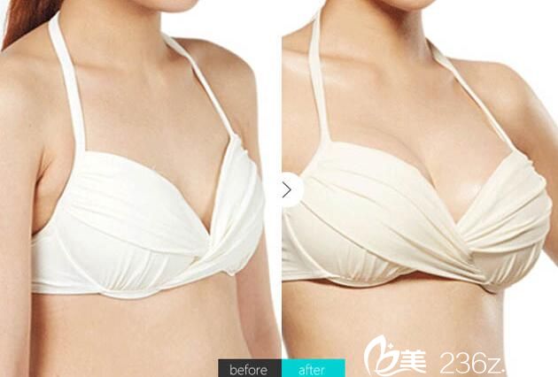 淮北相山時(shí)光王鋒院長(zhǎng)假體隆胸案例效果對(duì)比圖