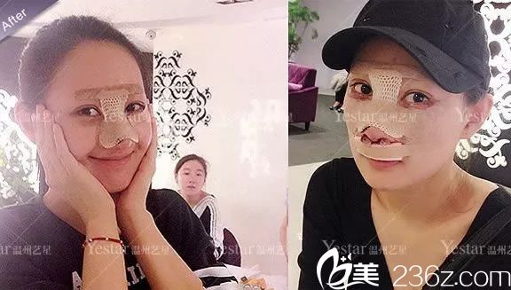 剛做完眼睛和鼻子手術(shù)照片