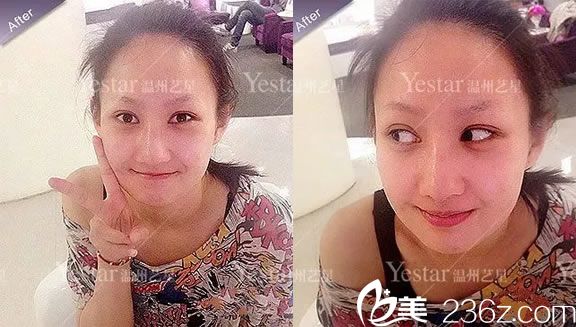 做完雙眼皮和隆鼻5天拆線<span style=