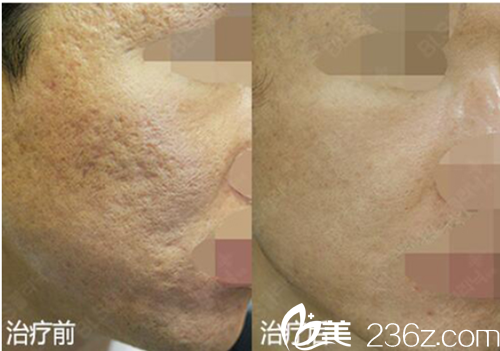 韓國BLS醫(yī)院祛痘印案例對比圖 韓國BLS醫(yī)院祛痘印案例對比圖