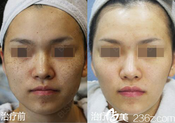 韓國BLS整形外科醫(yī)院祛色素對比圖 韓國BLS整形外科醫(yī)院祛色素對比圖