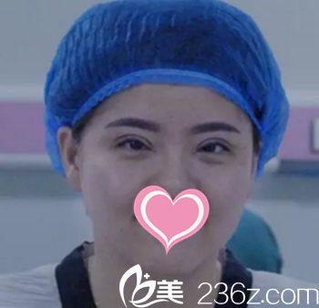 雙眼皮術(shù)后即刻效果展示 雙眼皮術(shù)后即刻效果展示