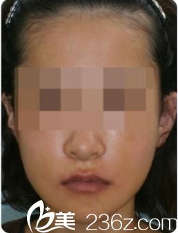 日本哪位醫(yī)生擅長(zhǎng)下巴整形?分享小木曾佑一醫(yī)生下巴削骨術(shù)手術(shù)真實(shí)經(jīng)過，帶你走進(jìn)日本小木曾(Kogiso)美容整形醫(yī)院