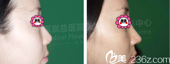 <!--<i data=20240703-sp></i>-->李敏硅膠假體隆鼻