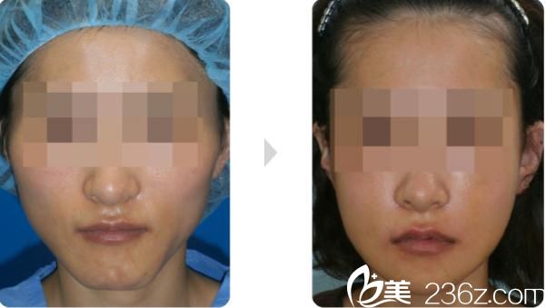 下頜骨削骨前后對比