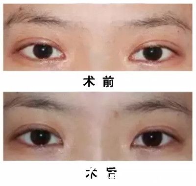韓國eve整形醫(yī)院鄭潤(rùn)載內(nèi)眼角修復(fù)真人前后對(duì)比
