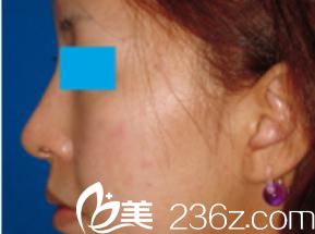 小木曾佑一醫(yī)生醫(yī)生到底怎么樣?說說我在Kogiso Clinic 做的硅膠隆鼻手術(shù)，宛如換臉!