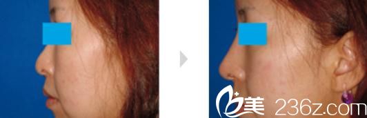 小木曾佑一隆鼻手術前后對比