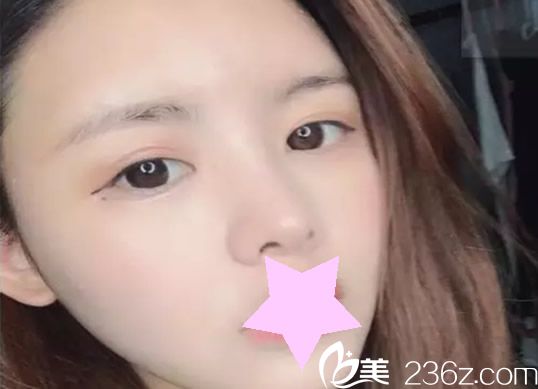 周誠面部吸脂第7天