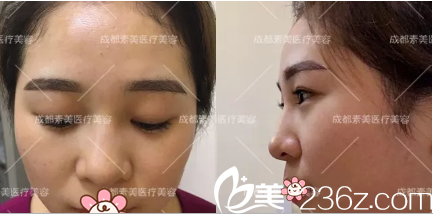 在素美做膨體隆鼻術(shù)前照片 在素美做膨體隆鼻術(shù)前照片