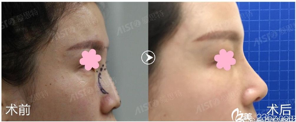 楊迪院長隆鼻前后對比圖