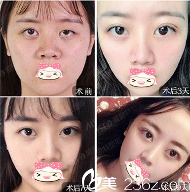 我在整形醫(yī)院做雙眼皮前后變化圖