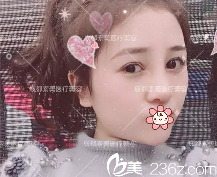<!--<i data=20240703-sp></i>-->歐美混血美鼻術(shù)后10天效果 <!--<i data=20240703-sp></i>-->歐美混血美鼻術(shù)后10天效果