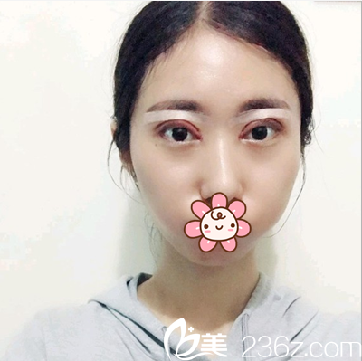 車紅昌切開雙眼皮開眼角術(shù)后當(dāng)天 車紅昌切開雙眼皮開眼角術(shù)后當(dāng)天