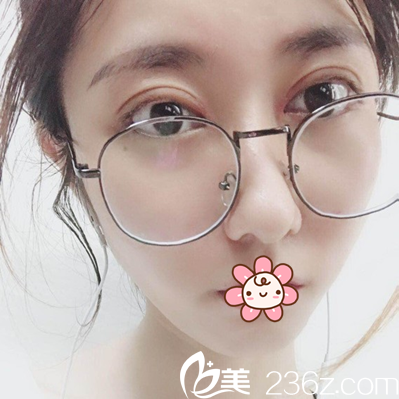 切開雙眼皮術(shù)后10天恢復(fù)效果 切開雙眼皮術(shù)后10天恢復(fù)效果