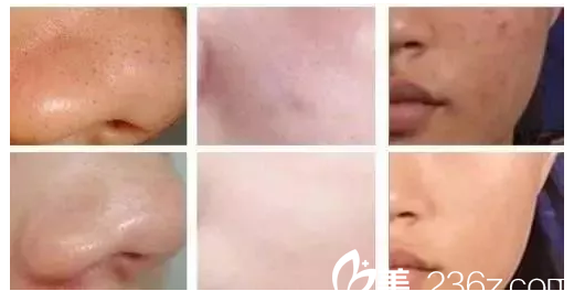 衡陽摩姿小氣泡的效果對比圖