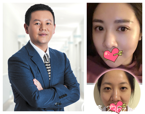 整形金志楊眼綜合案例 整形金志楊眼綜合案例