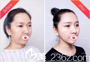 術后2周時與術前對比效果