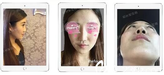 鄭州梨花雨顧客做隆鼻修復(fù)術(shù)前 鄭州梨花雨顧客做隆鼻修復(fù)術(shù)前