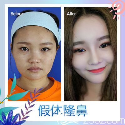 廣州廣美徐立志隆鼻案例 廣州廣美徐立志隆鼻案例