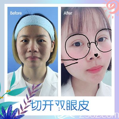 廣州廣美徐立志雙眼皮案例圖片 廣州廣美徐立志雙眼皮案例圖片