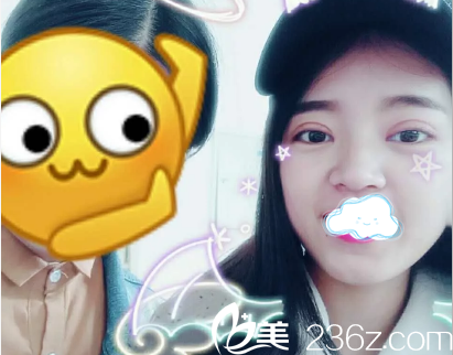 成都藝星雙眼皮術(shù)后7天恢復(fù)情況