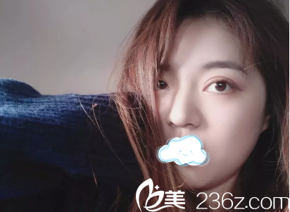 蔡靈雙眼皮術(shù)后一個(gè)月恢復(fù)照片