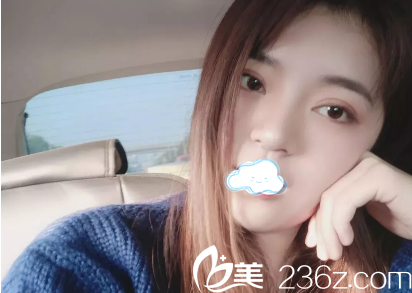 內(nèi)雙腫泡眼妹子找到“變雙”的正確方式 在成都yestar藝星找蔡靈了做雙眼皮手術(shù)