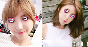 北京惠合嘉美瘦臉除皺瘦臉案例