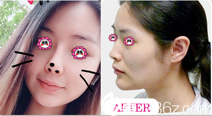 北京惠合嘉美醫(yī)院隆鼻多少錢？達拉斯定制鼻綜合15800元起