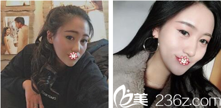 重慶好美整形雙眼皮術(shù)后3個月效果 重慶好美整形雙眼皮術(shù)后3個月效果