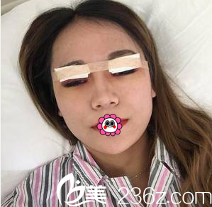 <!--<i data=20240703-sp></i>-->醫(yī)生給我做切開雙眼皮手術(shù)當(dāng)天樣子 <!--<i data=20240703-sp></i>-->醫(yī)生給我做切開雙眼皮手術(shù)當(dāng)天樣子