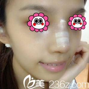 胡俊峰醫(yī)生給我做鼻綜合第4天樣子 胡俊峰醫(yī)生給我做鼻綜合第4天樣子