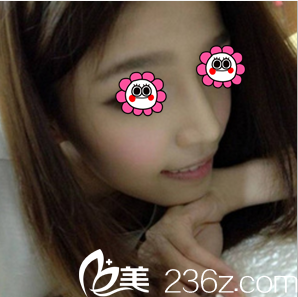 在北京惠合嘉美做膨體+耳軟骨綜合隆鼻第23天效果 在北京惠合嘉美做膨體+耳軟骨綜合隆鼻第23天效果