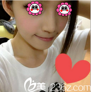 北京惠合嘉美膨體+耳軟骨鼻綜合案例 北京惠合嘉美膨體+耳軟骨鼻綜合案例