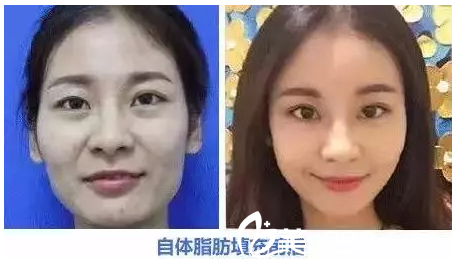 邵陽德美自體脂肪填充前后對比
