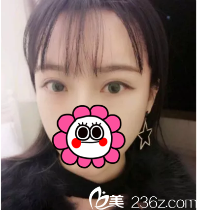 我一個(gè)留學(xué)生朋友給我推薦了李明鐘，后來我在韓國諾寶絲做了雙眼皮手術(shù)