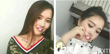 重慶好美整形埋線提升術(shù)后一個(gè)月效果 重慶好美整形埋線提升術(shù)后一個(gè)月效果