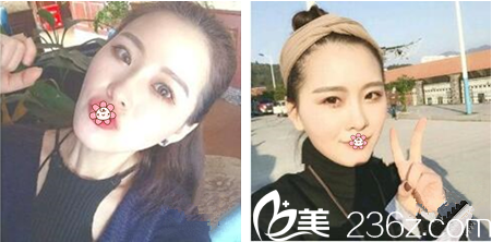 重慶好美整形楊東運(yùn)埋線提升術(shù)后2個(gè)月 重慶好美整形楊東運(yùn)埋線提升術(shù)后2個(gè)月