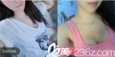 北京禾美嘉真C自體脂肪隆胸活動案例