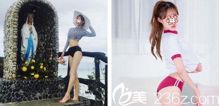 畢勝腰腹吸脂術(shù)后半個月