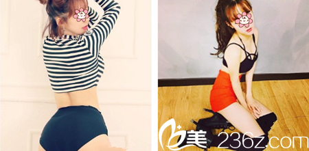 重慶好美整形吸脂怎么樣