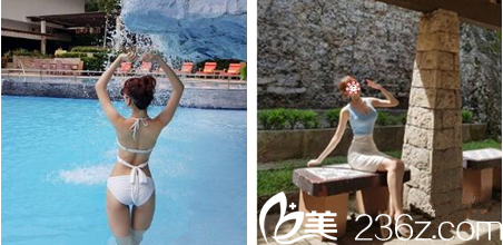 重慶好美整形吸脂術(shù)后三個月