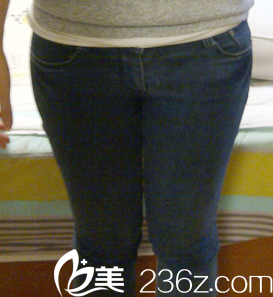 在北京惠合嘉美做腿部吸脂前樣子 在北京惠合嘉美做腿部吸脂前樣子