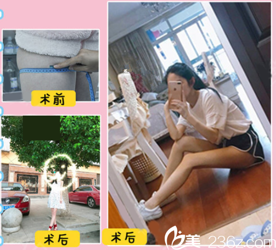 贛州亞韓360°水動力吸脂手術(shù)，德國進(jìn)口水動力吸脂儀器，術(shù)后安全不反彈，助你成功瘦身