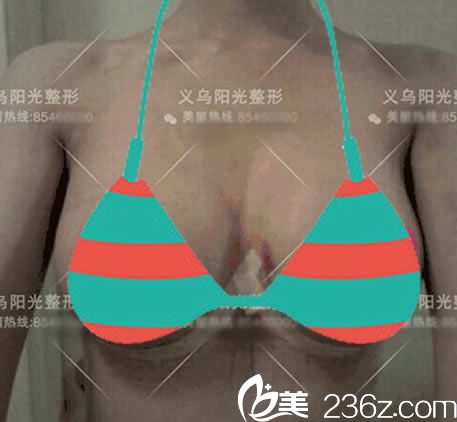 義烏陽光醫(yī)院剛做完隆胸的圖片 義烏陽光醫(yī)院剛做完隆胸的圖片