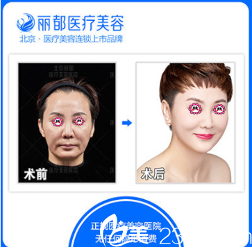 北京米蘭柏羽麗都于曉春面部埋線提升案例