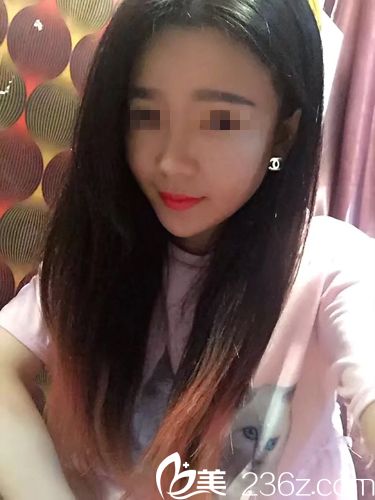 埋線提升術(shù)后一周效果