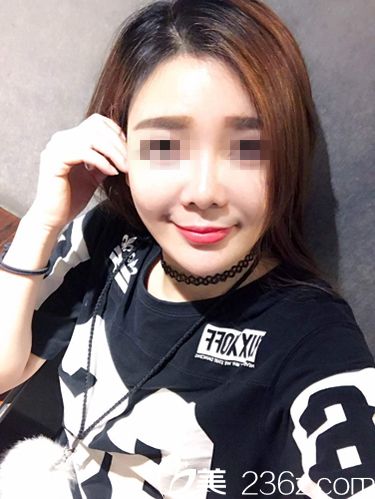 面部埋線提升術(shù)后一個(gè)多月效果