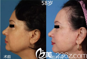 西安阿姨在濟(jì)南做的smas整形手術(shù)術(shù)前照